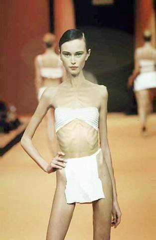 Anorexic Girls Photos
