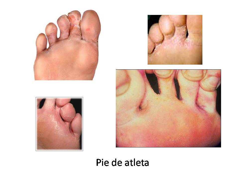 Micosis superficiales Dermatofitosis (Tiñas)