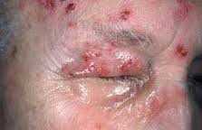 obat herpes di wajah