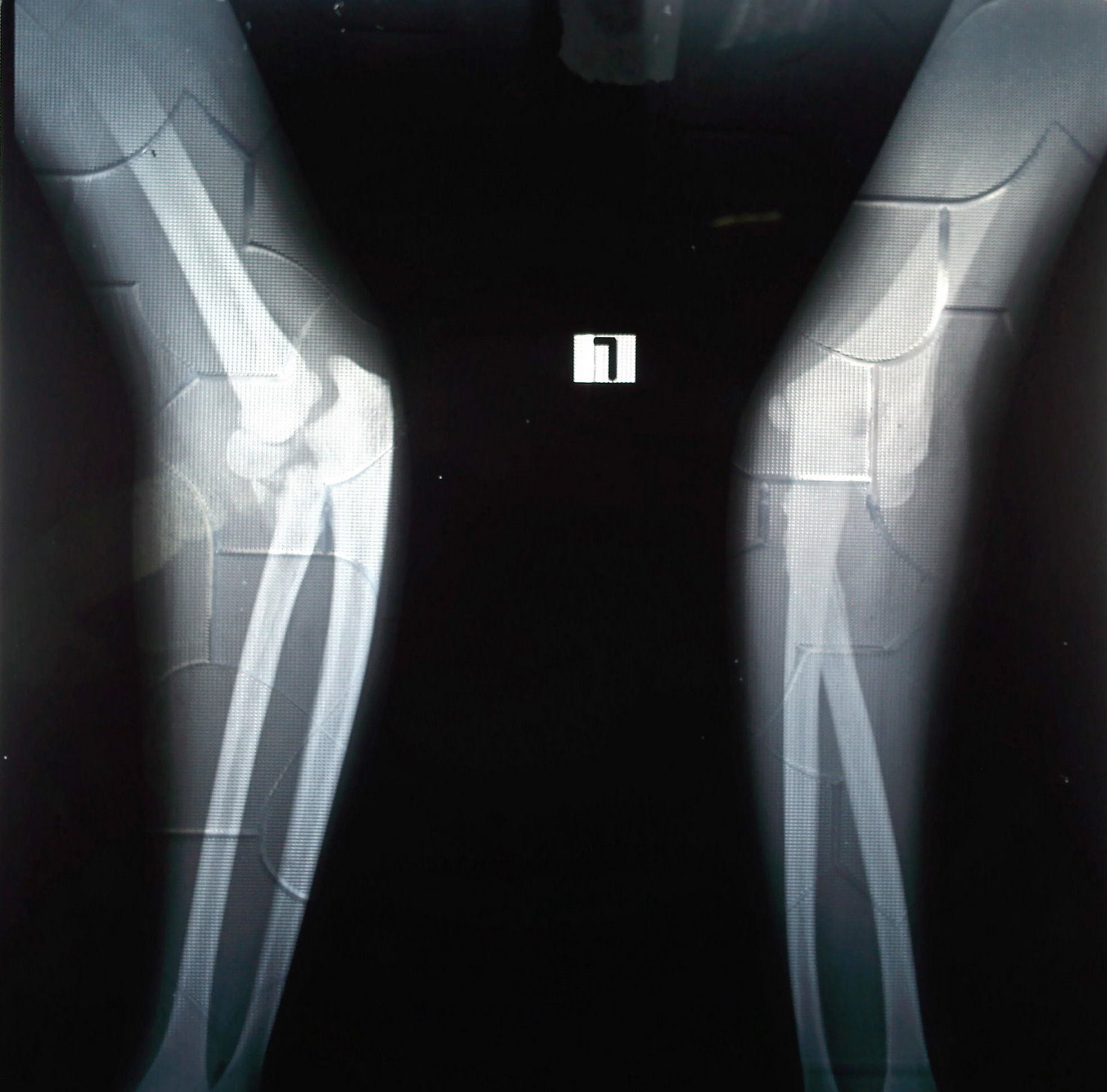Clinical images Total Hip Replacement