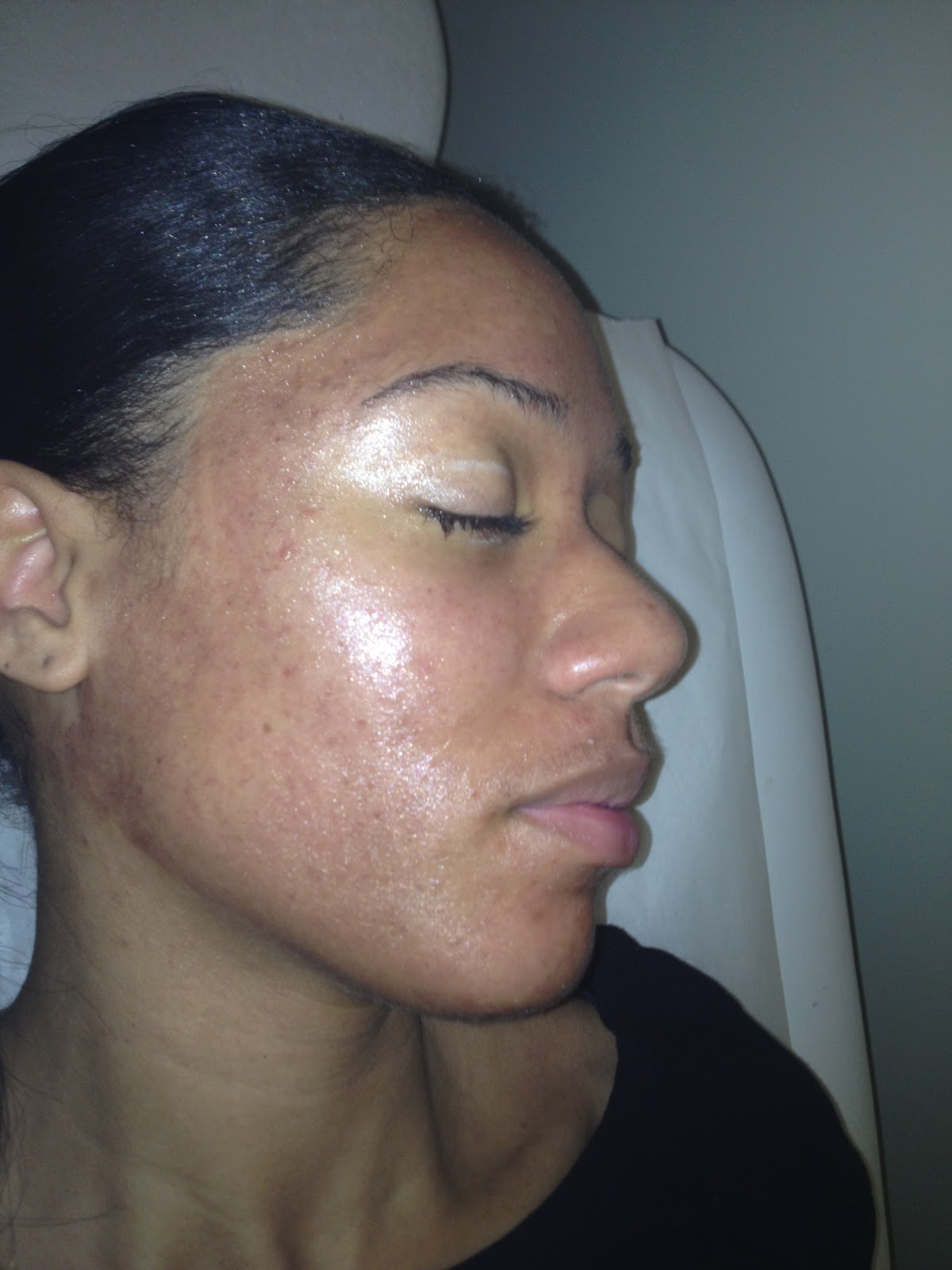 CHEMICAL PEEL Day 1 Vedette Beauty, Skin & Health