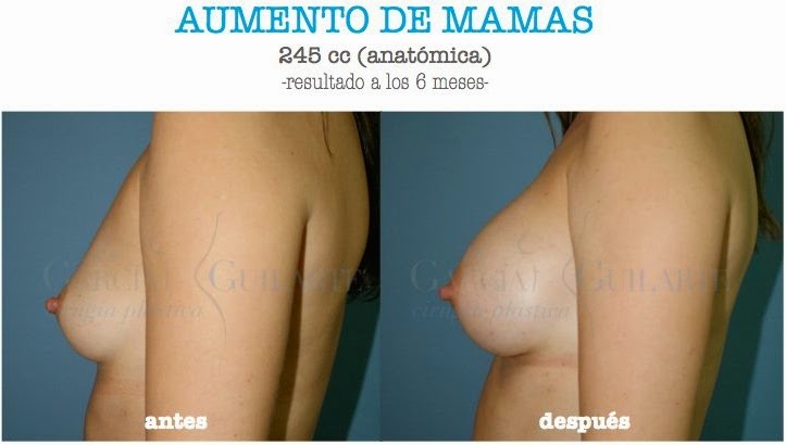 Las operaciones de la reconstitución del pecho después de la desaparición
