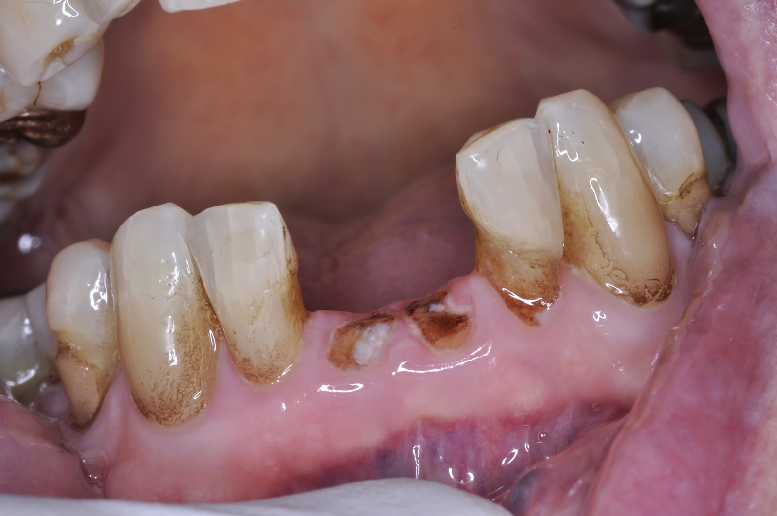 Ask Dr. Spindel How should the area under a pontic be