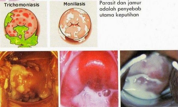 Penyakit keputihan tidak normal Penyakit keputihan tidak normal