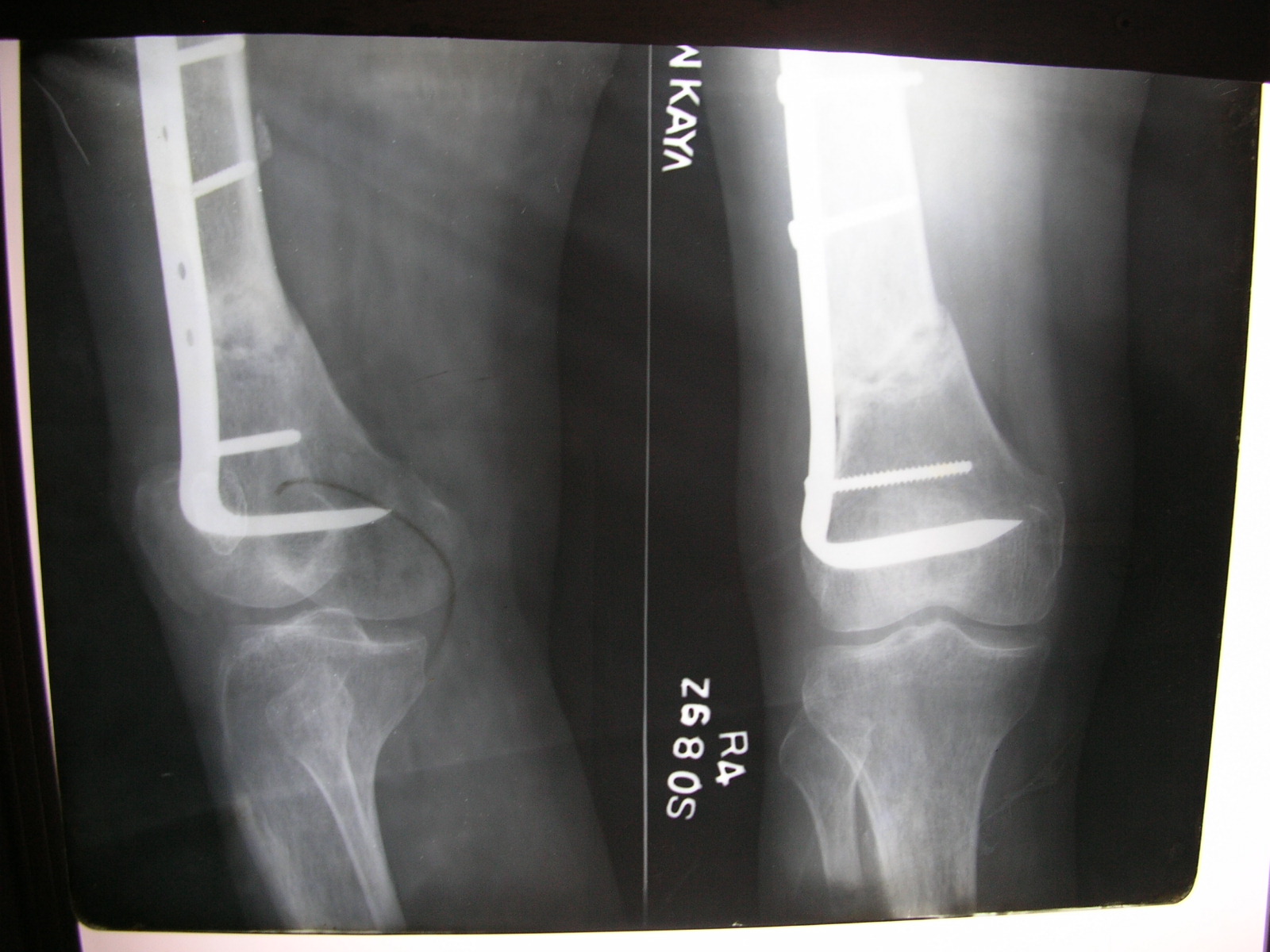 Xrays and Slides Nonunion of angled blade plate of supracondylar