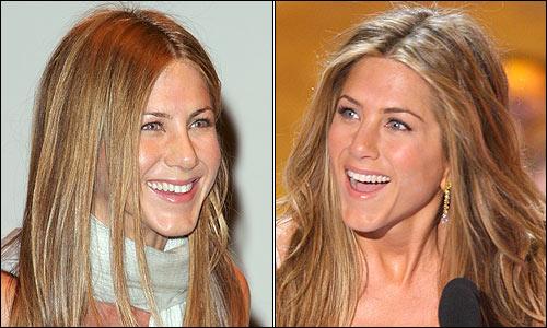 Op Dr Taha Mehmetoglu Burun Estetiki