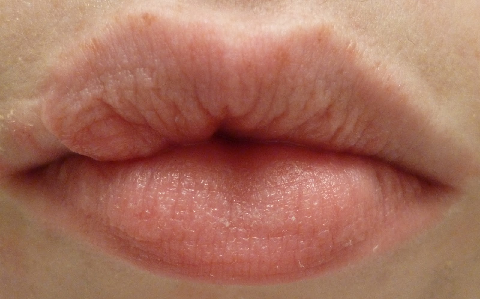 Chapped Lips Images