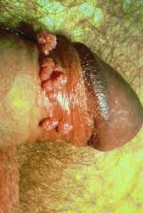 Kutil Kelamin Kutil Kelamin