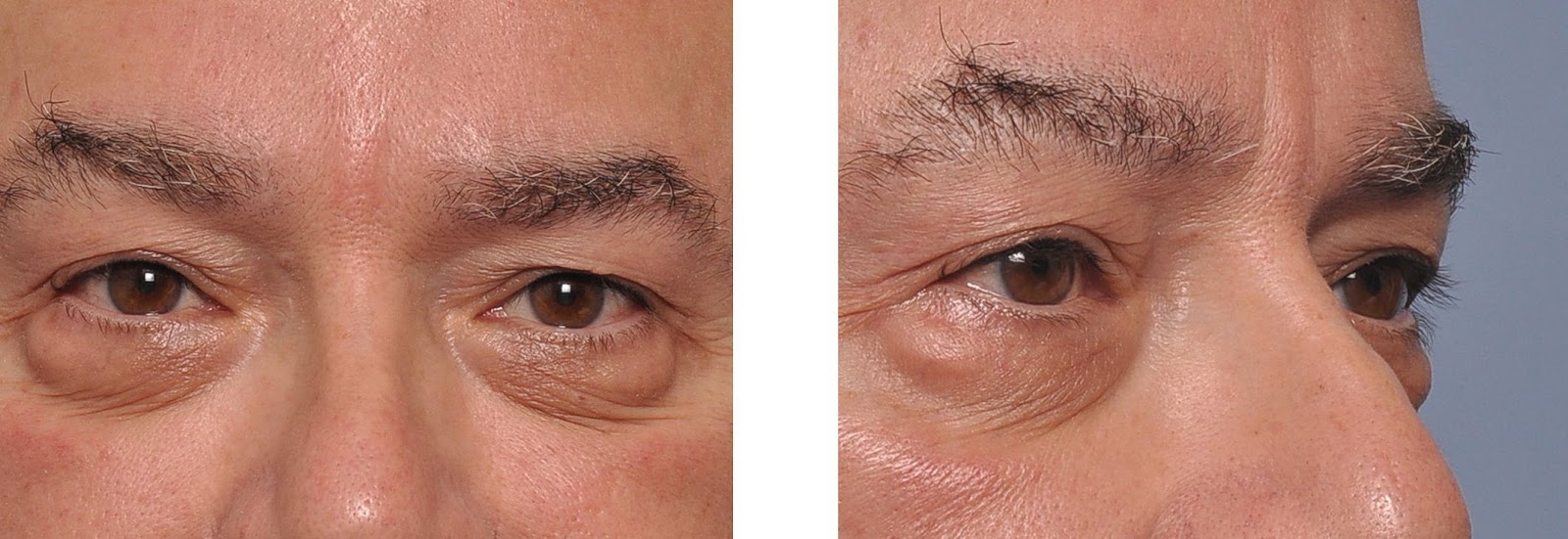 The Inner Secrets To Facial Toning And Workouts For Natural Facelifts