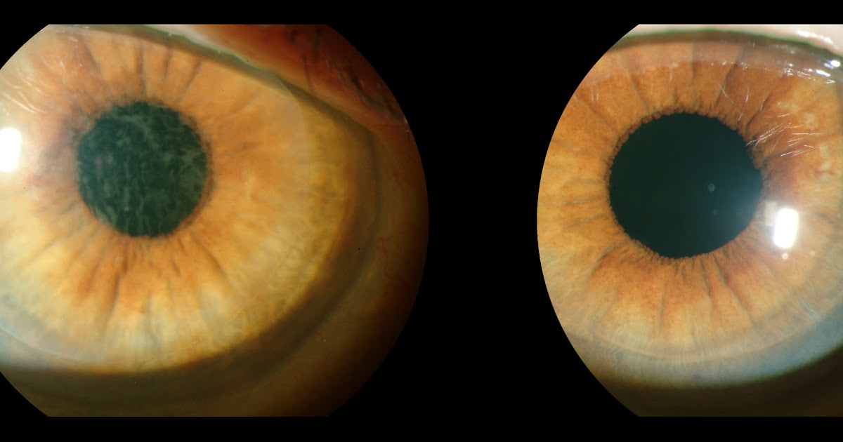 Whitman Images Cloudy Cornea