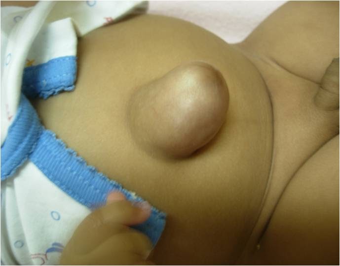 Umbilical Hernia In Children