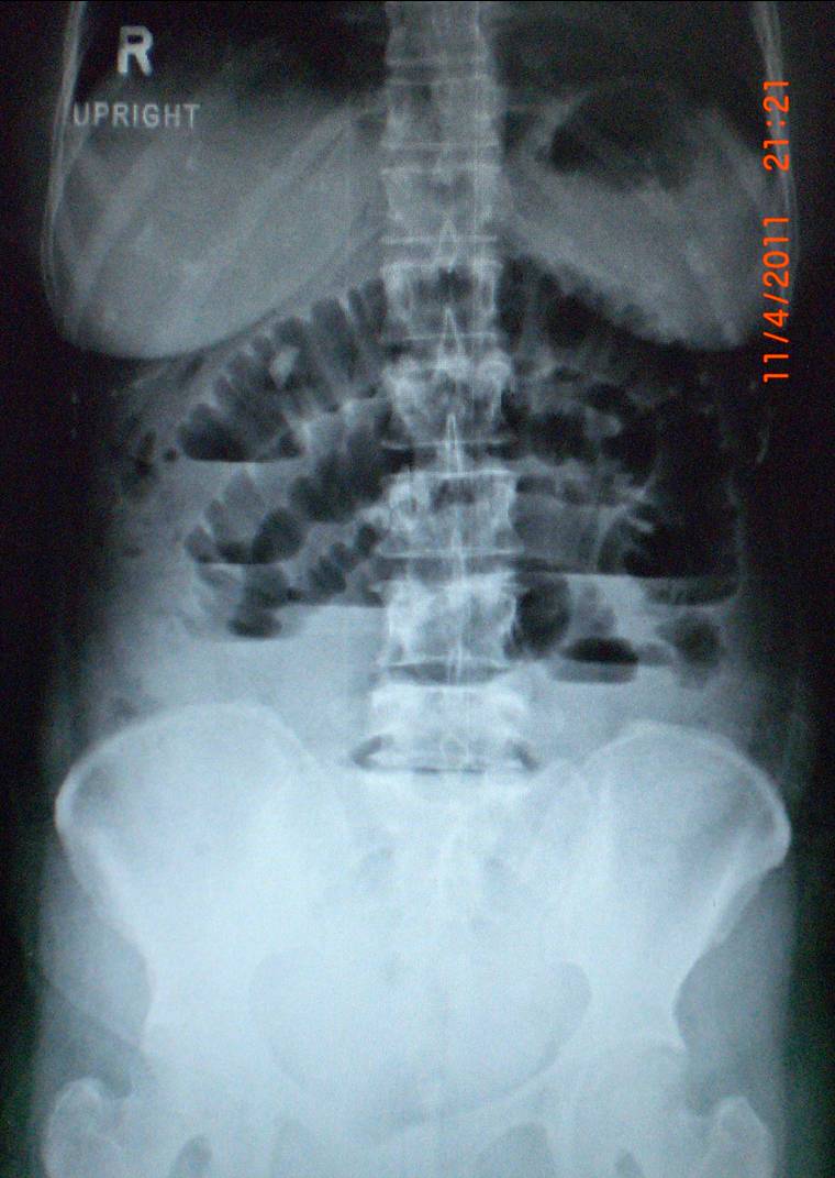 Phimaimedicine 1,092. Small bowel obstruction