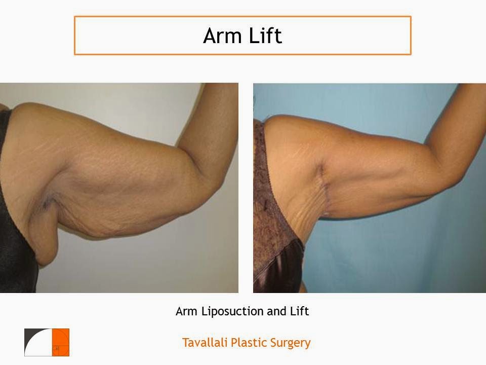 Medical Treatment Picturesfor Better Understanding Arm Lift Surgery