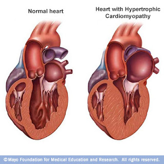 Living 4 Zachary: Do you know what Hypertrophic Cardiomyopathy really is?