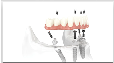 Stamford dental implants