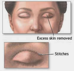 Upper Eyelid Blepharoplasty