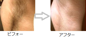 オーガニックコスメ 脇 黒ずみ