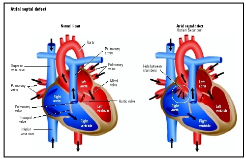 Patent ductus arteriosus symptoms