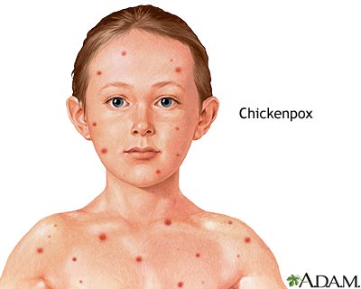 Chicken Pox – Causes, Symptoms, Treatment and Prevention