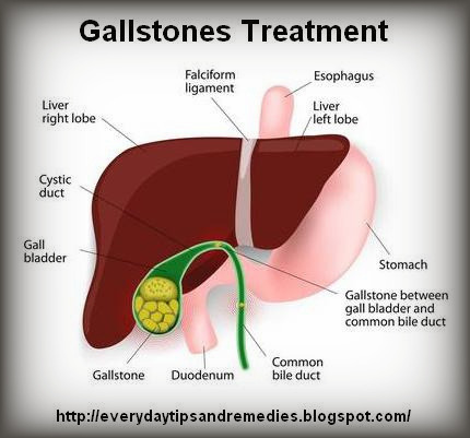 Tips And Remedies: Gallstones Treatment