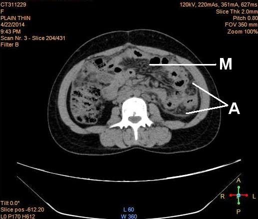 abdominal tuberculosis ct