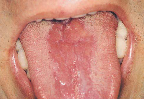 Mouth Patch Symptom Thrush