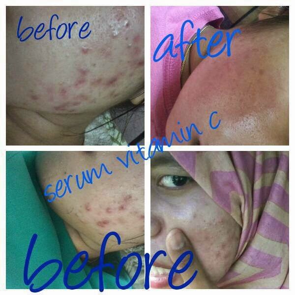 Berapa Serum Vit C simplyaddorable serum vit c n kulit lebih cerah dan gebu Berapa Serum Vit C simplyaddorable serum vit c n kulit lebih cerah dan gebu