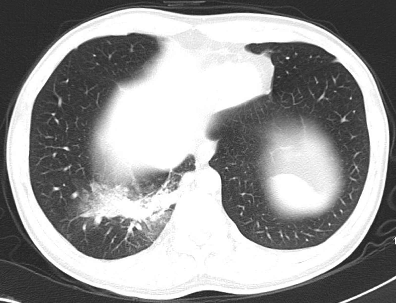 sequestrated lung segment ct