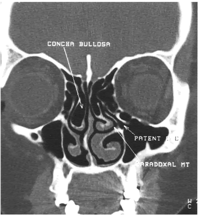 Ct+scan+sinus