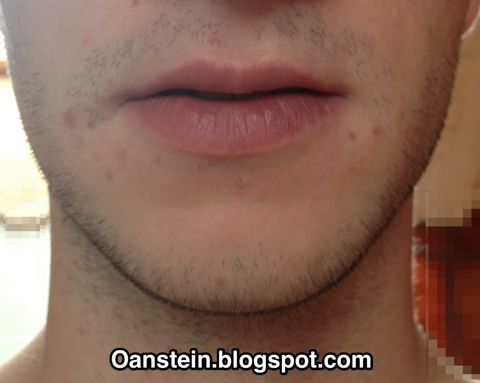 Oanstein Experiment Bartwuchs Beschleunigen Aktivieren Und Fordern Bartlucken Beseitigen Minoxidil Update 8