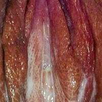 sipilis sipilis