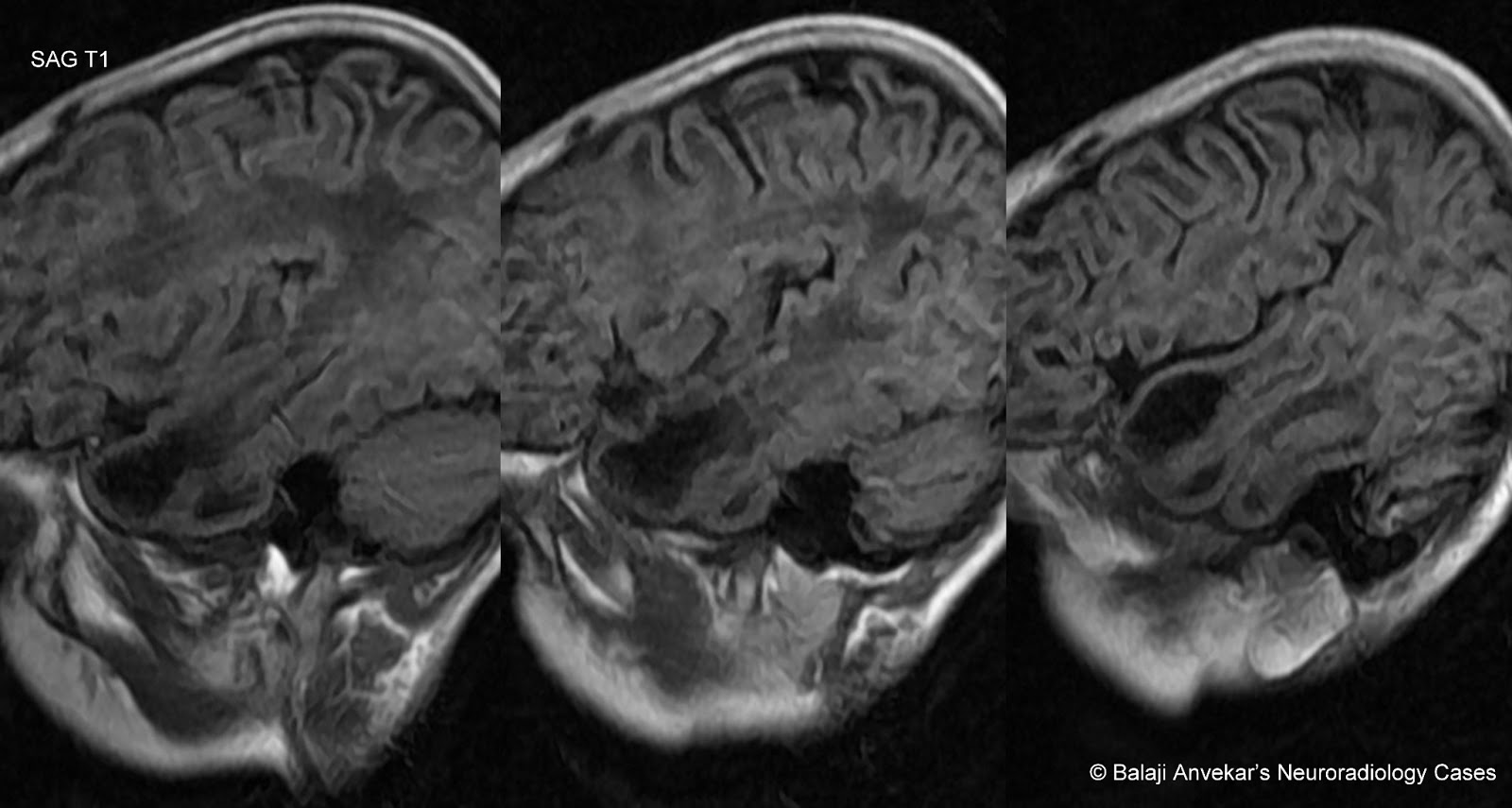 Dr Balaji Anvekar FRCR Van Der Knaap Leukoencephalopathy MRI