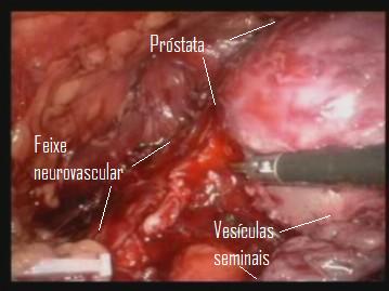 Urolaparoscopia