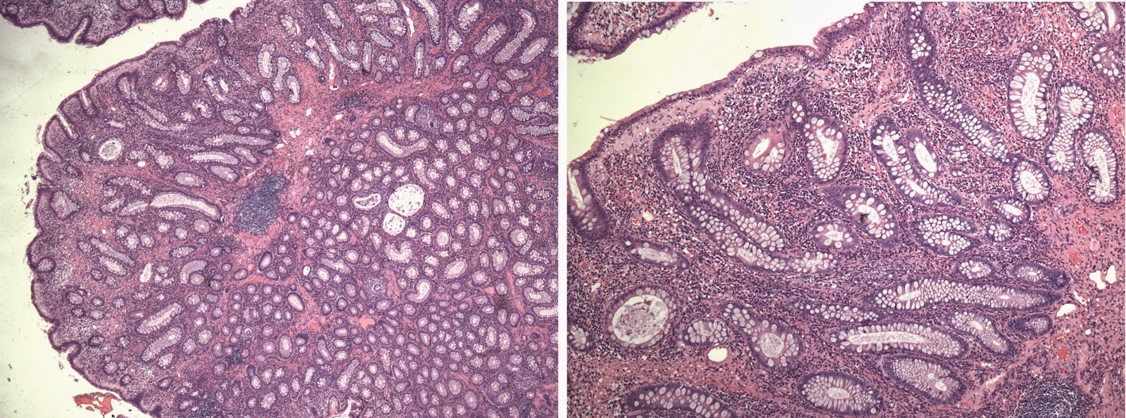 Colonic Polyps In Children From Benign To Serious