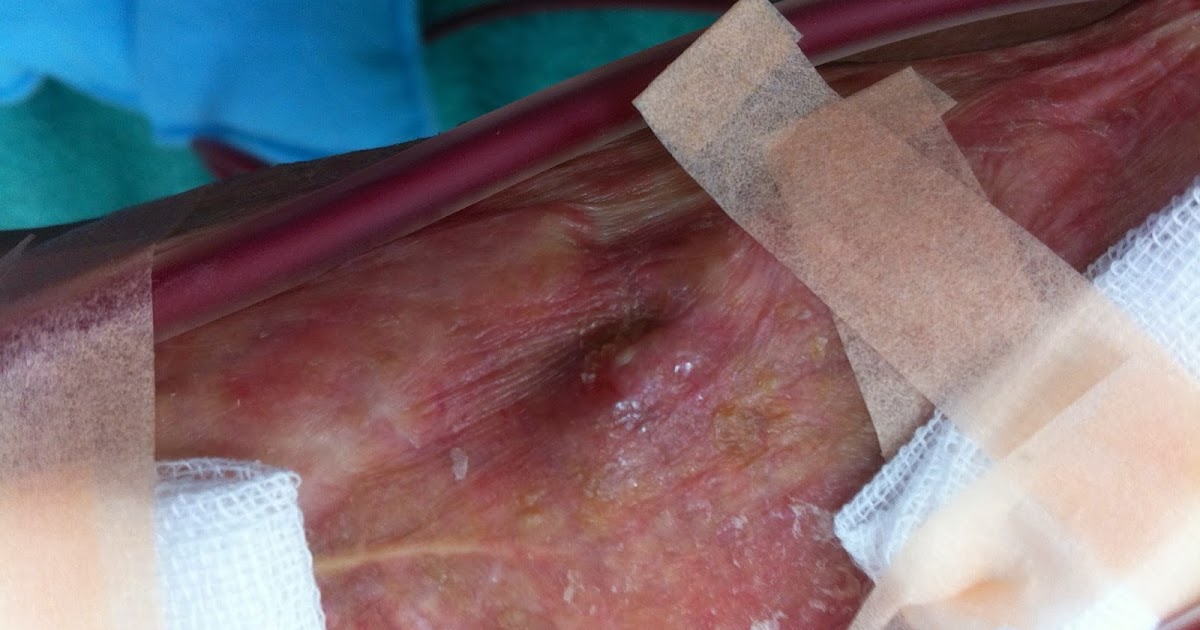 透析患者のつぶやき デブリードマン