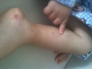 El Ayak Agiz Popo Hastaligi Ne Menem Bir Hastaliktir Gokalp Ile Seyr I Alem