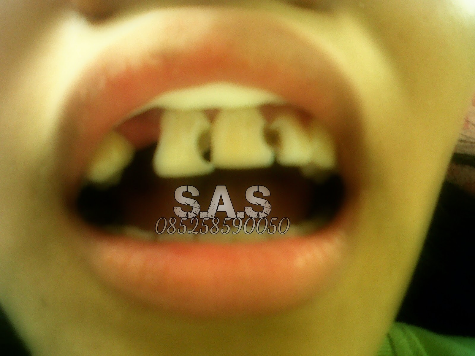 1 2 3 Gigi Berlubang, Keropos dan Hitam Serta Hasil ...