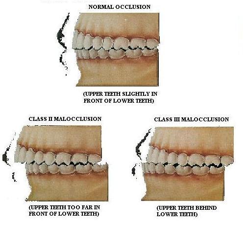 malocclusion