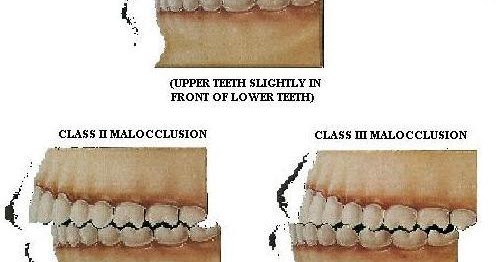 types of malocclusion of teeth