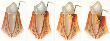 Houston Dentures Houston Dentures