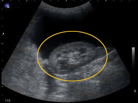 RENAL STONES ( KIDNEY STONES ), Causes Of Kidney Stones, Signs And