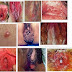 Obat buat penis yang lecet karena gatal digaruk ?