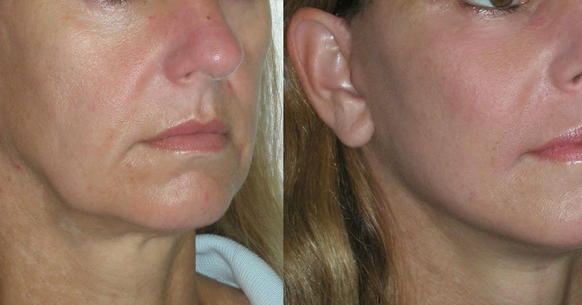 Effective Yoga Face Exercises To Look A Decade Younger Fast Got Hollow