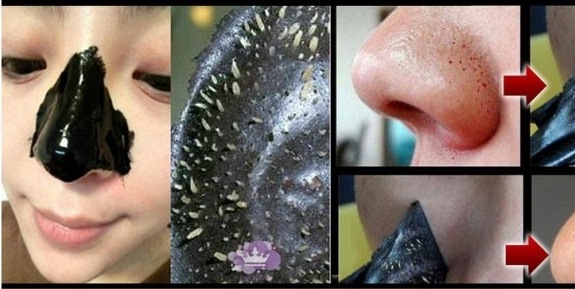 how to get rid of blackheads overnight home remedies how blackheads form