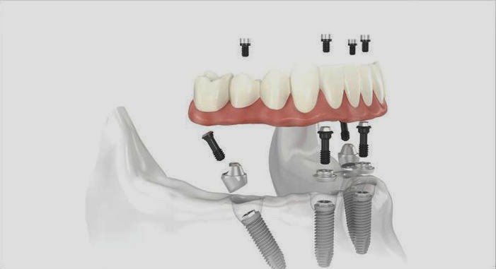 All-on-4 Dental Implants