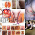 Obat Wasir (Ambeien) Tradisional Yang Terbukti Manjur thumbnail