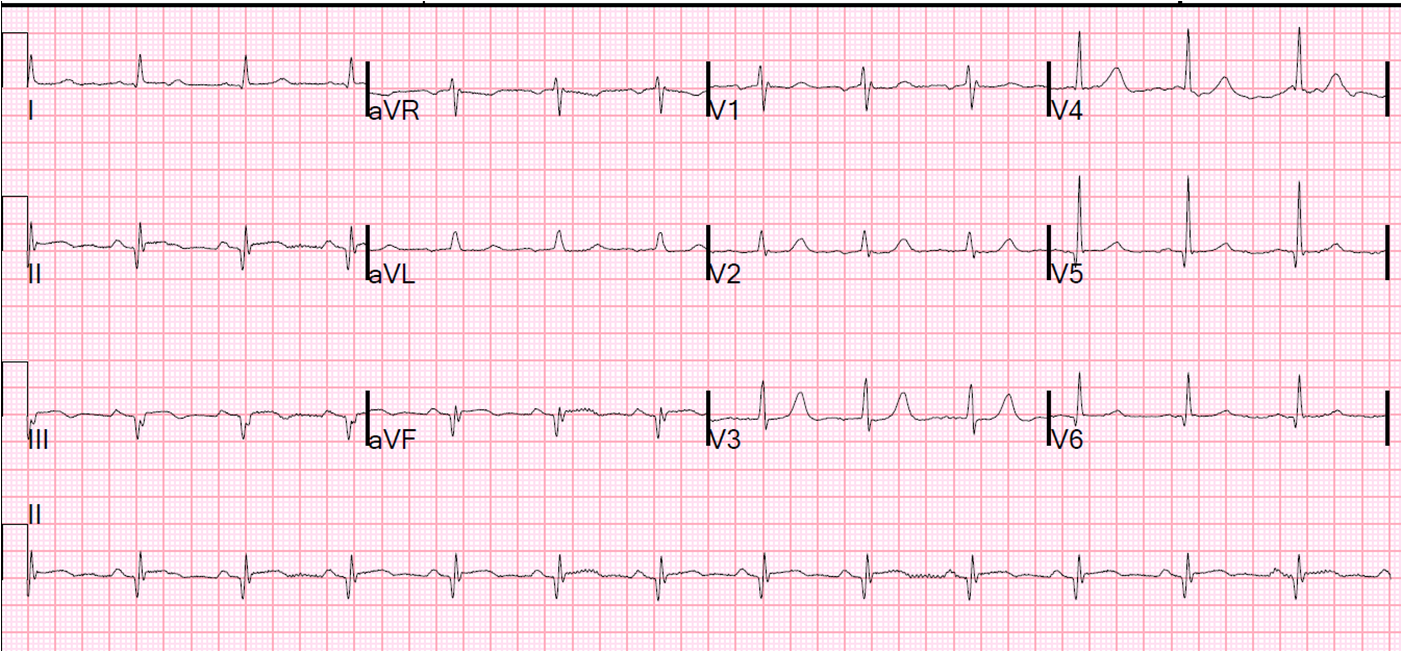 Dr. Smith's ECG Blog Chest pain and Bradycardia