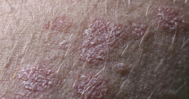 Atopichesky la dermatitis el tratamiento por la homeopatía