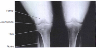 Knee PA Axial Rosenberg Method