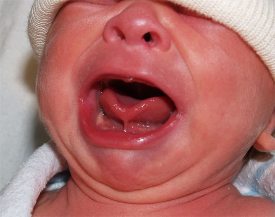 Tongue Tied Infant Upper Lip